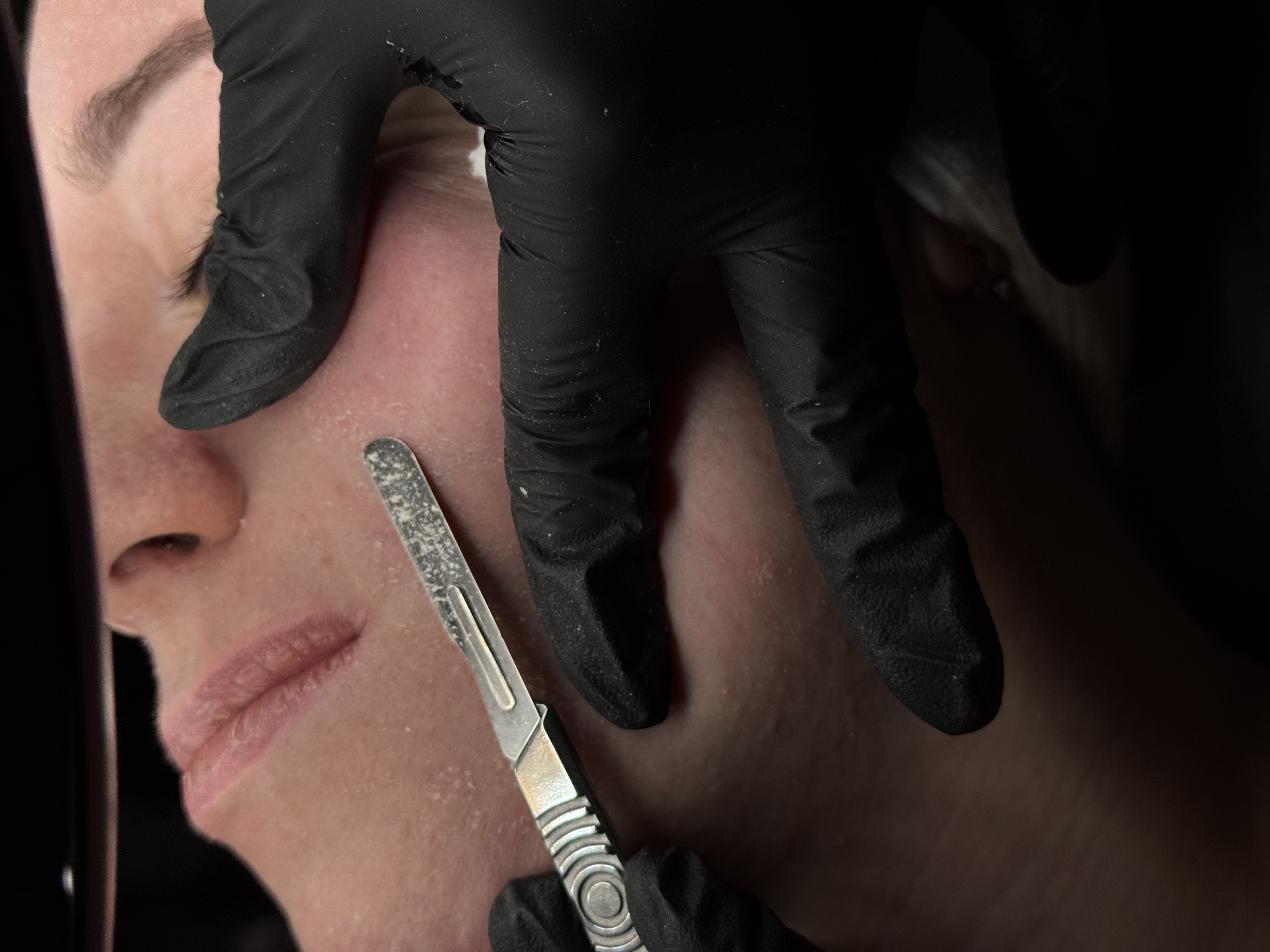 Gloved practitioner using a dermaplaning tool on a client's cheek