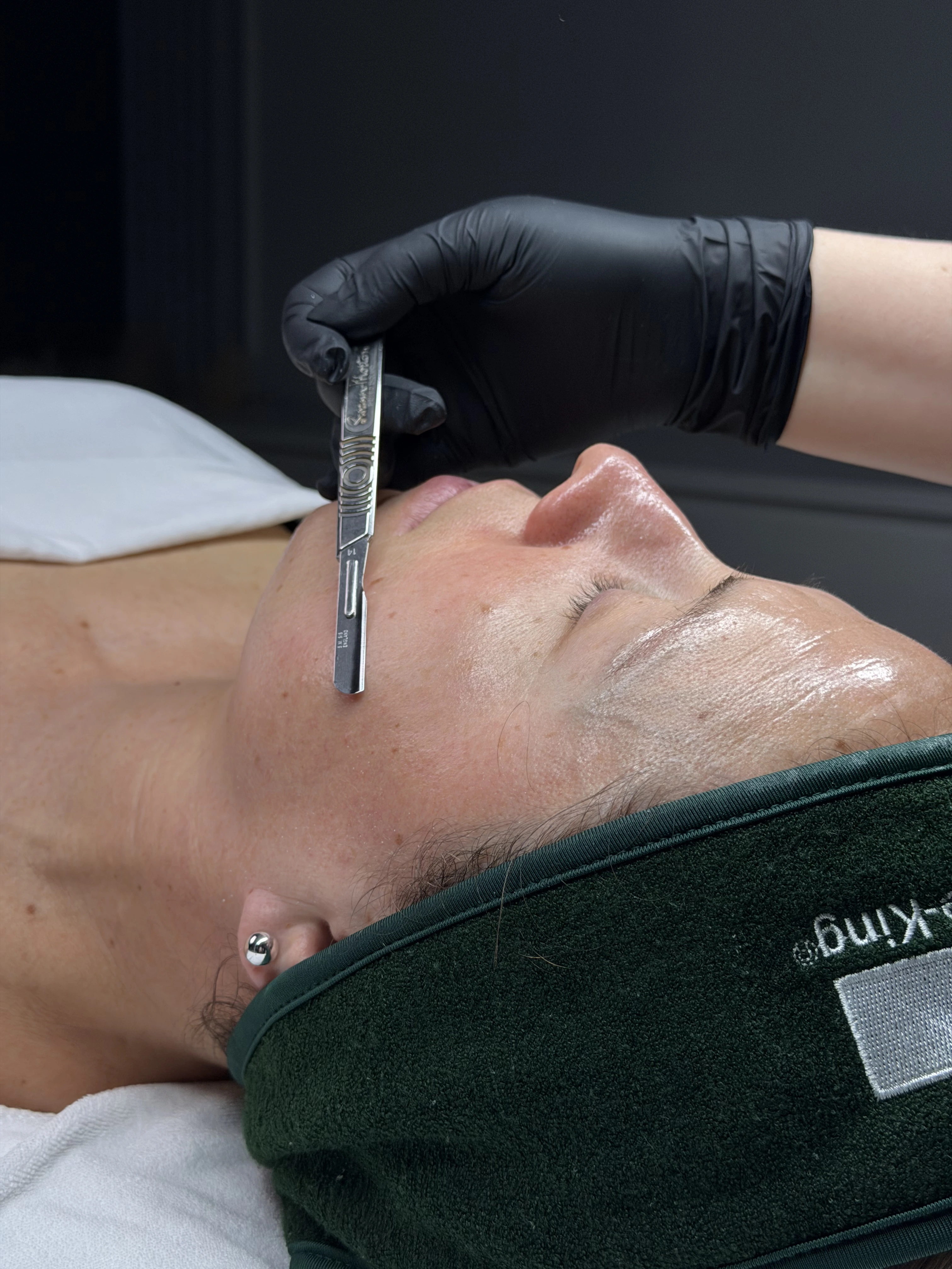 smooth glowing skin after dermaplaning facial treatment in Valencia